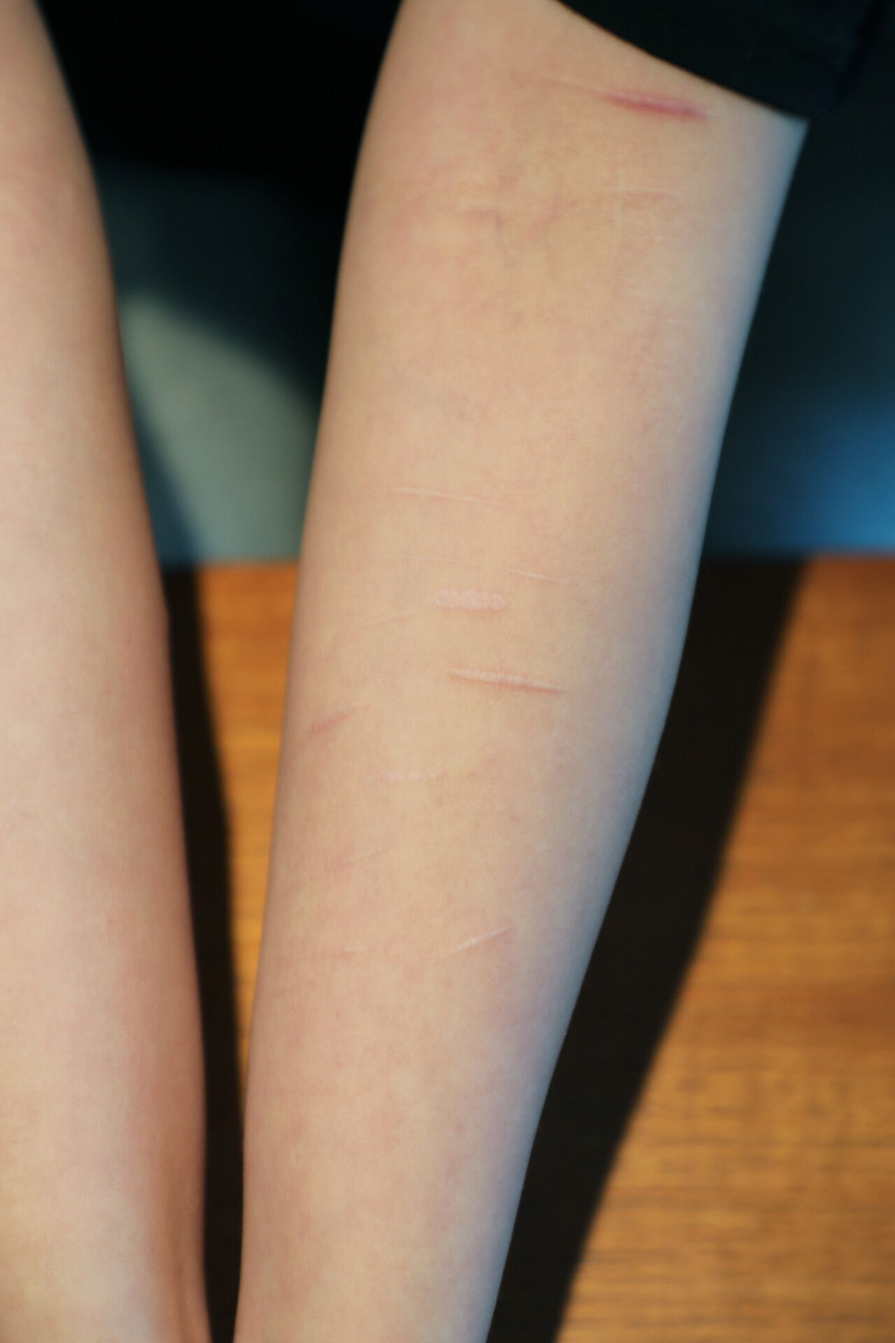 이 씨의 팔에는 마약 투약 중 자해로 인해 생긴 흉터가 가득하다. 사진 김정현